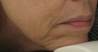Fraxel re:pair CO2 laser for mouth, lip, and jowls
