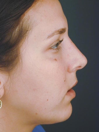 Female Chin Implant