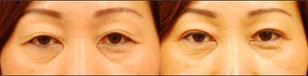 Asian Eyelid Surgery for Excess Skin