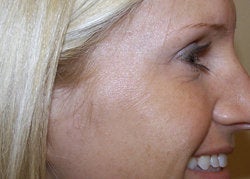 Botox to the Crow's Foot Area