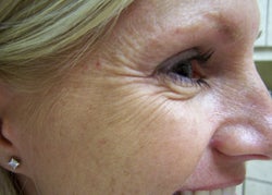 Botox to the Crow's Foot Area