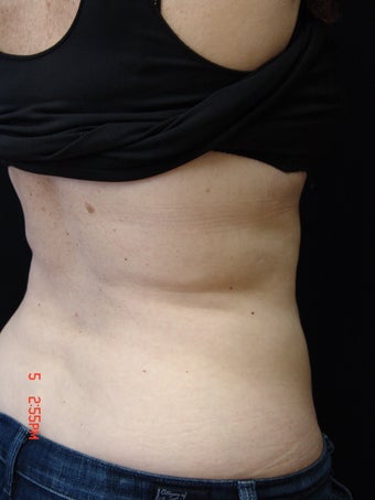 Coolsculpting