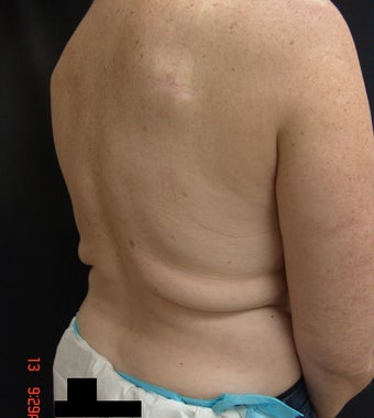 Coolsculpting