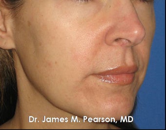 Melasma Treatment