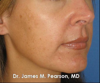 Melasma Treatment