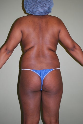 Brazilian butt lift case