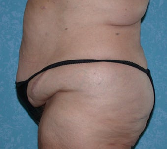 Circumferential Body Lift with Liposuction to Upper/Outer Abdomen