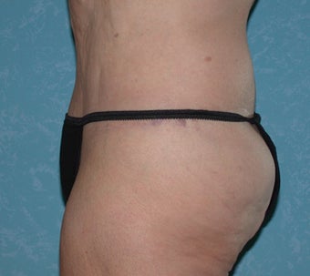 Circumferential Body Lift with Liposuction to Upper/Outer Abdomen
