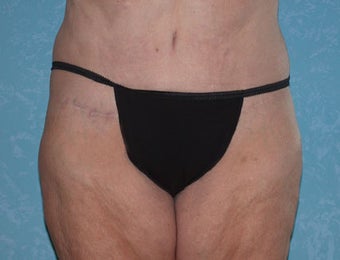 Circumferential Body Lift with Liposuction to Upper/Outer Abdomen