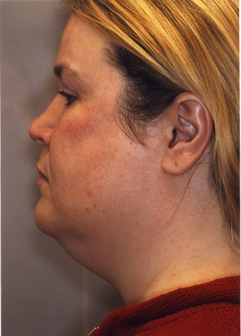 Neck Liposuction