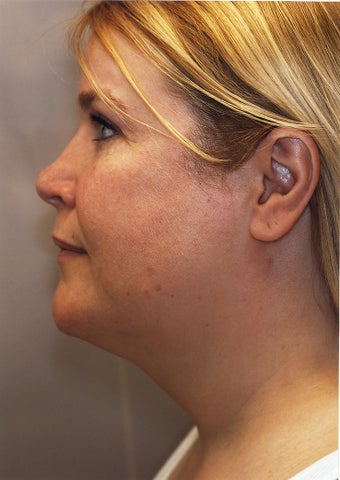 Neck Liposuction