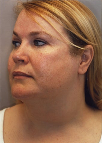 Neck Liposuction