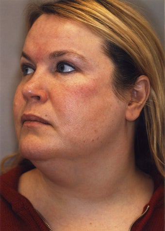 Neck Liposuction