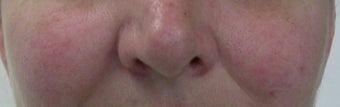 50 year old Female Treated for Rosacea and Facial Veins