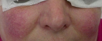 50 year old Female Treated for Rosacea and Facial Veins