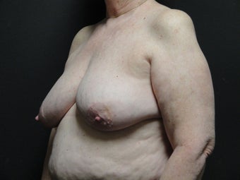 Breast reconstruction - Implants