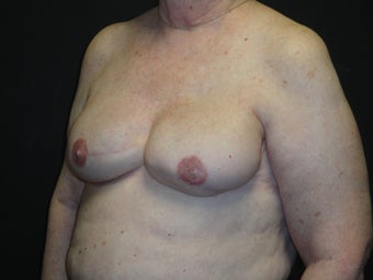 Breast reconstruction - Implants