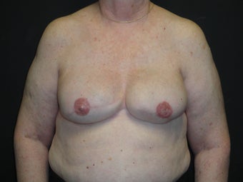 Breast reconstruction - Implants