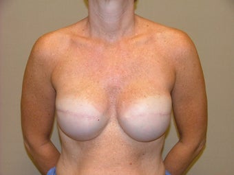 Breast Reconstruction