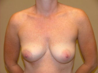 Breast Reconstruction