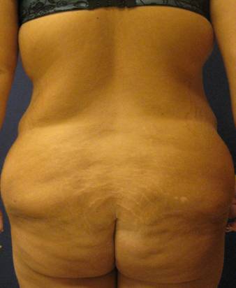 Body Lift After Major Weightloss 