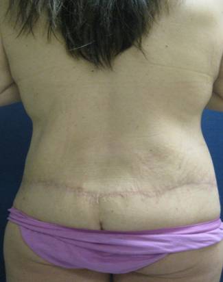 Body Lift After Major Weightloss 