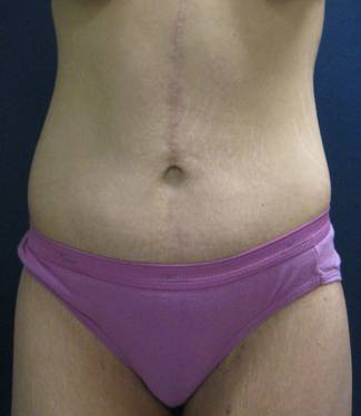 Body Lift After Major Weightloss 