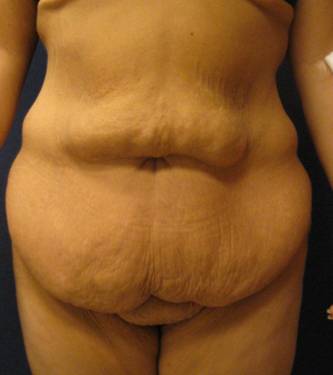Body Lift After Major Weightloss 