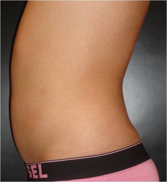 SmartLipo MPX