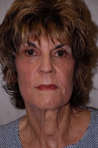 Photofacial, Melange Peel and Skin Tightening