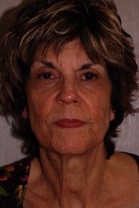Photofacial, Melange Peel and Skin Tightening