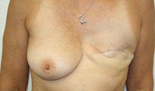 Breast Reconstruction