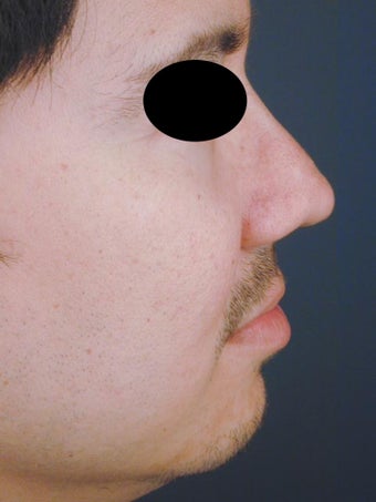 Male Chin Implant