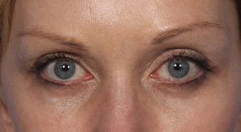 Eyelid Surgery