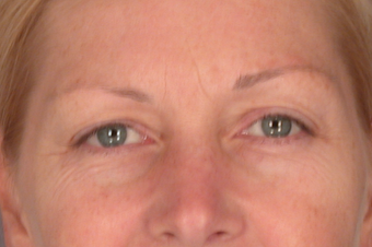 Eyelid Surgery