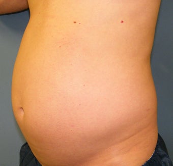CoolSculpting