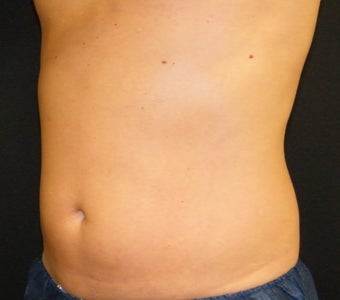 CoolSculpting