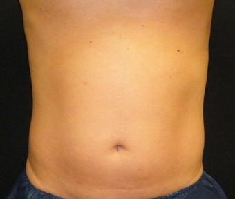 CoolSculpting