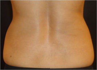 SmartLipo MPX
