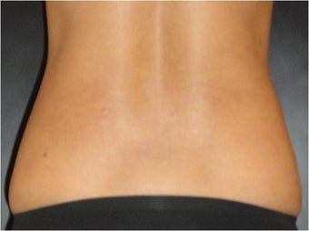 SmartLipo MPX