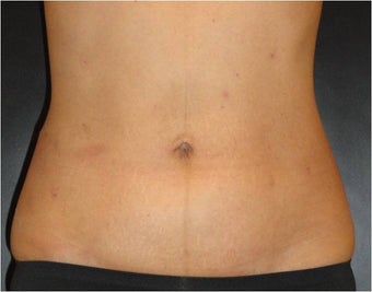 SmartLipo MPX