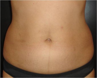 SmartLipo MPX