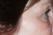 Botox