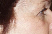 Botox