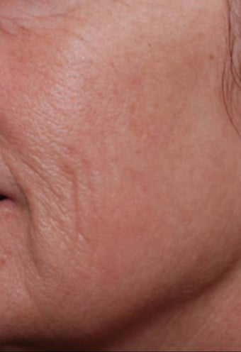 Female treated for Sunspots/Photoaging