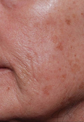 Female treated for Sunspots/Photoaging