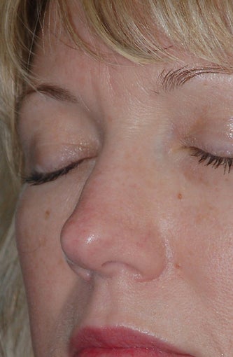 Non-Surgical Rhinoplasty