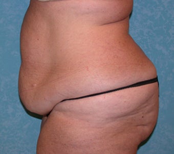 Circumferential Body Lift