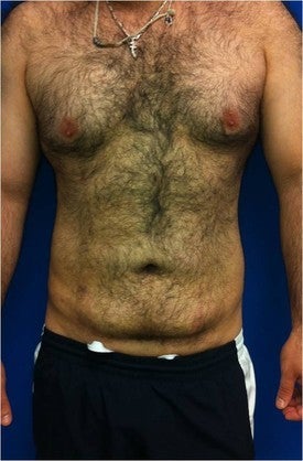 Laser Lipo