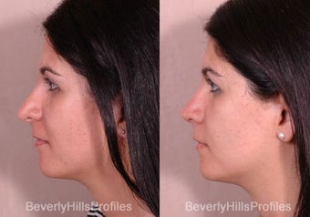 Revision Rhinoplasty